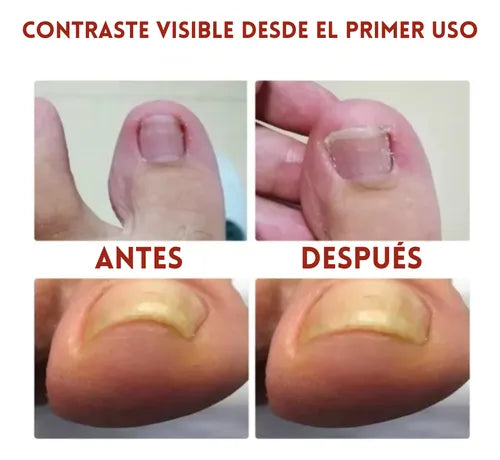 Super Oferta 2x1 NailRenew Pro ¿Quieres uñas fuertes y saludables?